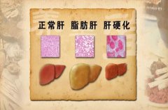 健康！紅酒竟是脂肪肝“天敵”